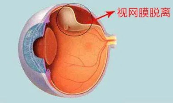 “网红”听多了，“网脱”听说过吗？——合肥爱尔眼科