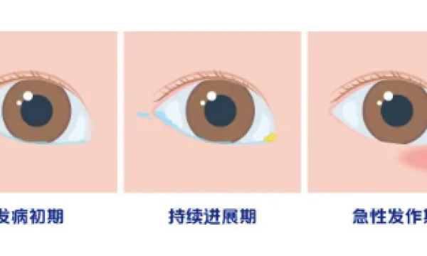 合肥爱尔眼科专家科普：先天性泪道阻塞