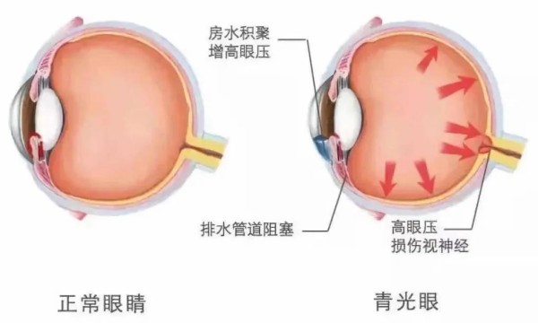 任何年龄都可能患上青光眼——合肥爱尔眼科专家解答