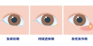 合肥爱尔眼科专家科普：先天性泪道阻塞
