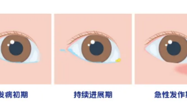 合肥爱尔眼科专家解析：先天性泪道阻塞