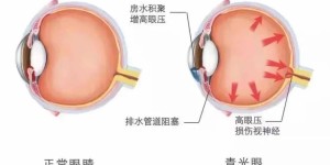 合肥爱尔眼科专家解答：青光眼会损伤视神经，防治不能太大意